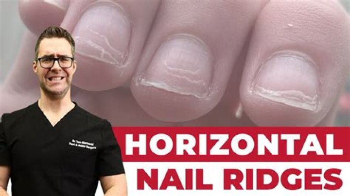 Horizontal Ridges on Your Nails: Causes, Treatments, and What They Indicate