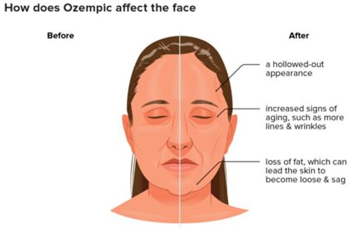 Ozempic Side Effects: A Comprehensive Guide to Understanding Before and After