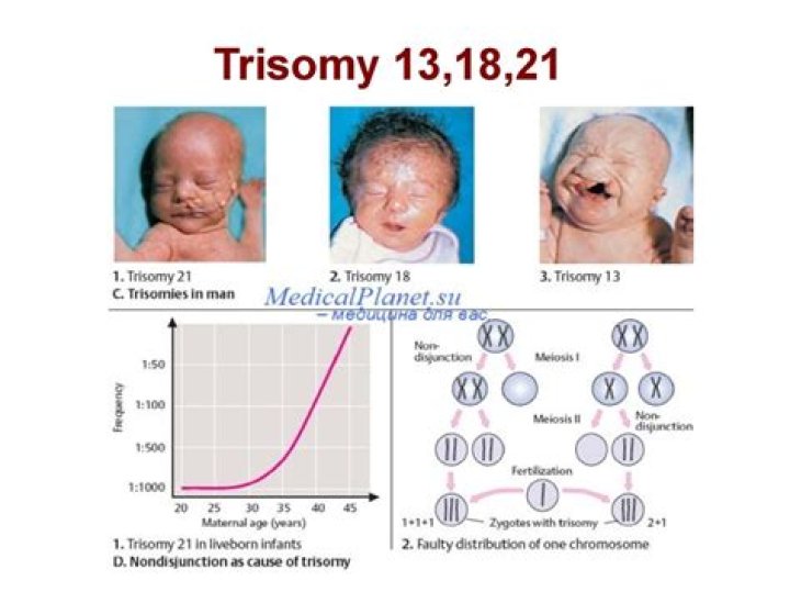 Understanding Trisomy 13 Mosaicism: Causes, Symptoms, Diagnosis, and Management