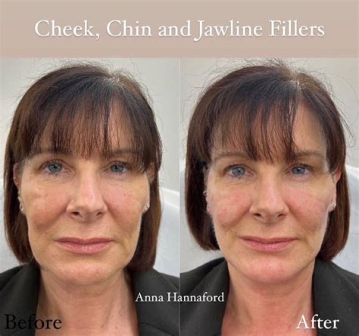 What Happens to Fillers Over Time: A Comprehensive Guide