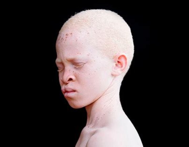 World's Whitest Man: Unveiling the Extraordinary Story and Fascinating Facts